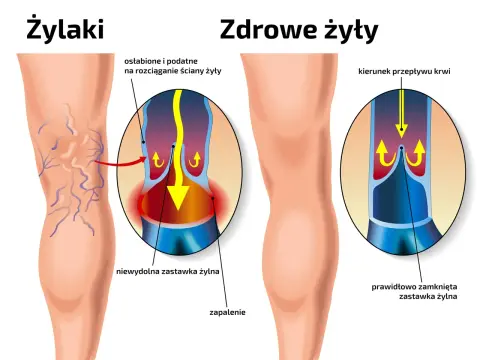 Bieganie a żylaki - Czy to bezpieczne? Sprawdź!
